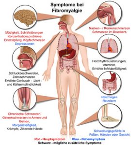 Symptome bei Fibromyalgie